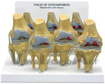 Stage-4 Osteoarthritis Knee Joint Model